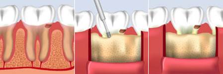 What is Crown Lengthening 5