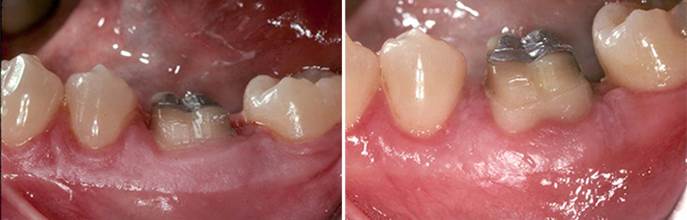 What is Crown Lengthening 6