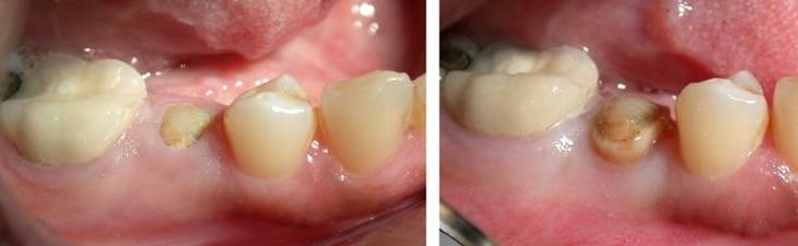 What is Crown Lengthening 7