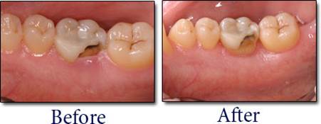 What is Crown Lengthening 8