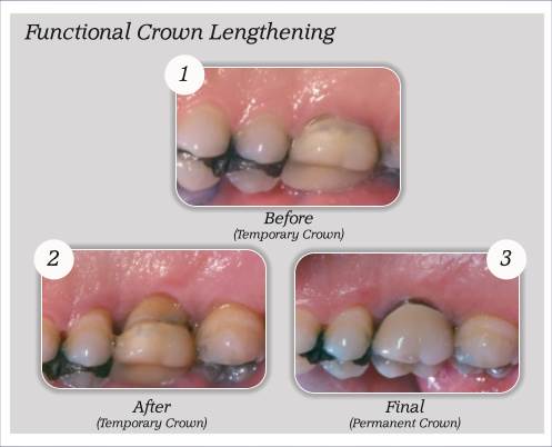 What is Crown Lengthening 9